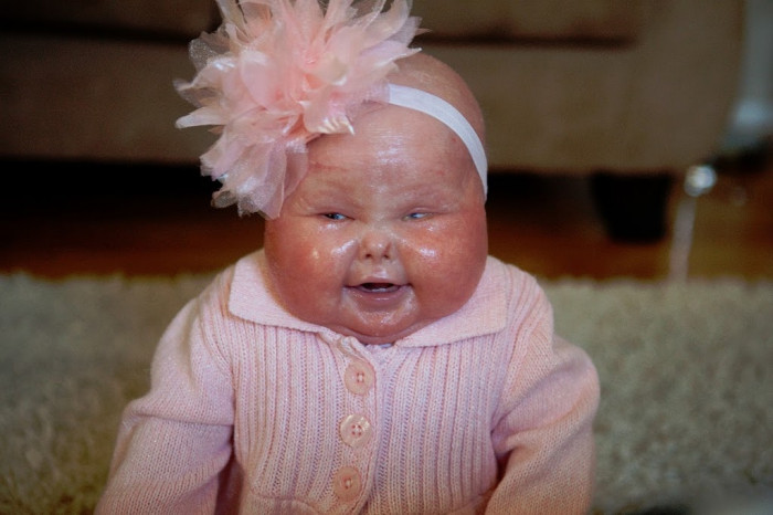 8 Most Notable Cases Of Harlequin Baby | Stillunfold