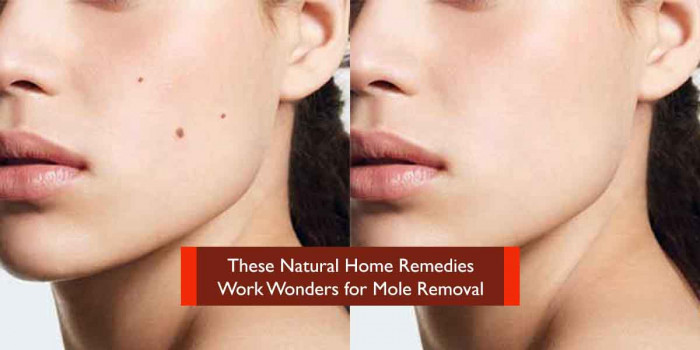 11 Tried-and-Tested Home Remedies for Removing Moles Naturally