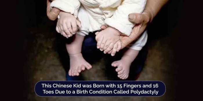 A Chinese Baby Named Honghong has 31 Fingers & Toes Due to a Rare Birth Condition 