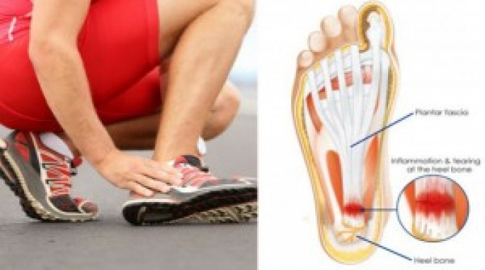 No More Painful Heels! Read About Cures for Plantar Fasciitis