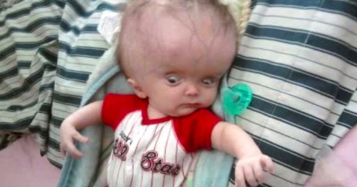 No Reason To Avoid This Baby Born With Swollen Head 