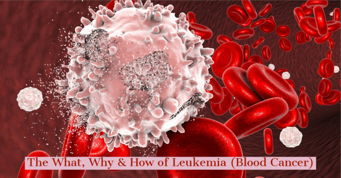 The What, Why & How of Leukemia (Blood Cancer)