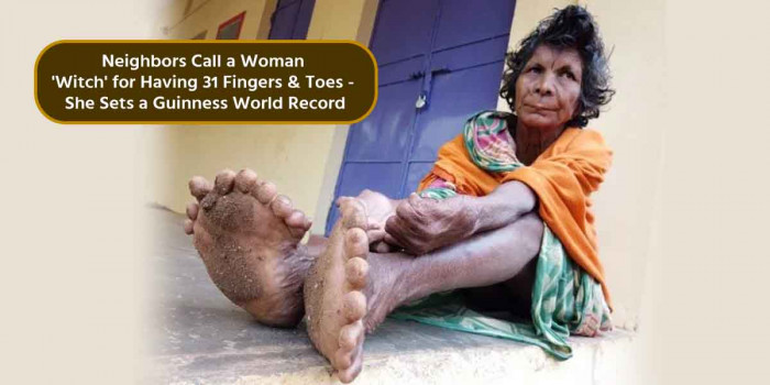 This Woman Broke the Guinness World of Record for Having 31 Fingers & Toes