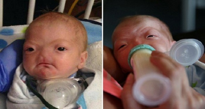 बिना नाक के पैदा हुए 2 बच्चो की प्रेरणादायक कहानी